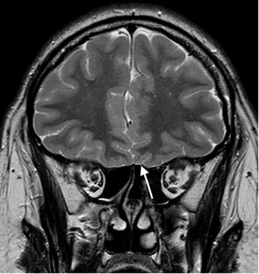 Case Report: Multiple prolactinomas in a young man with Kallmann syndrome and familial hypocalciuric hypercalcemia